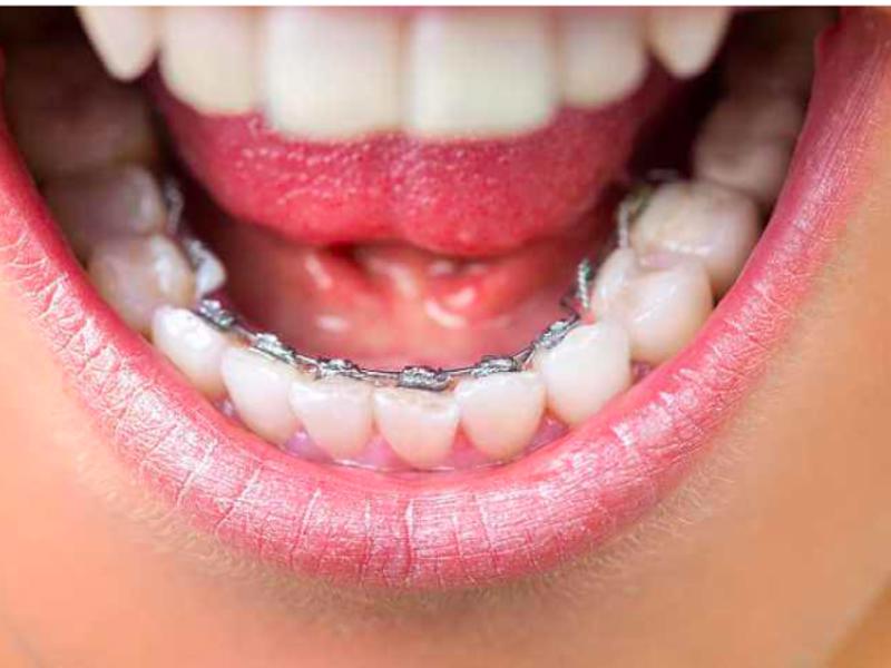 İçten Diş Teli Tedavisi Nasıl Olur?