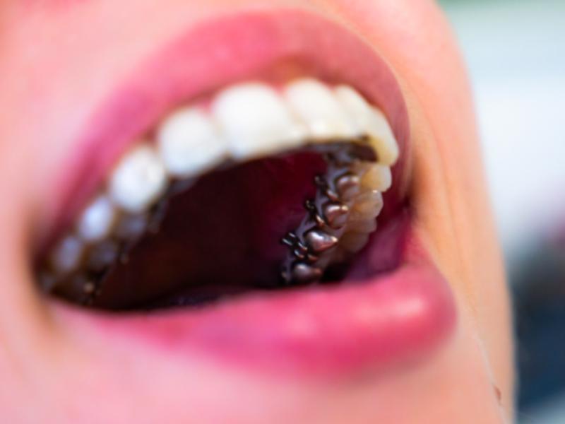 Lingual Teller Kullanmalı Mıyım?