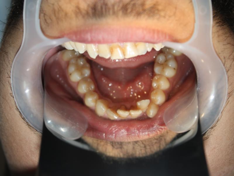 Ortodonti tedavisi tek çeneye uygulanabilir mi