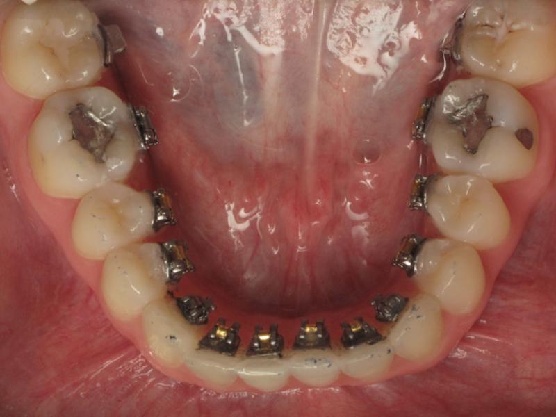 Ortodonti tedavisinden sonra dişlerimde bozulma olur mu