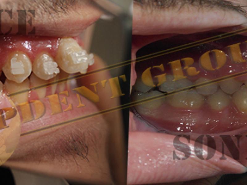 Ortodonti tedavisine kaç yaşında başlanmalıdır