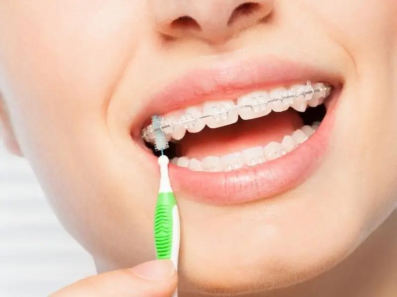 Şeffaf Diş Teli Çabuk Mu Sararır?